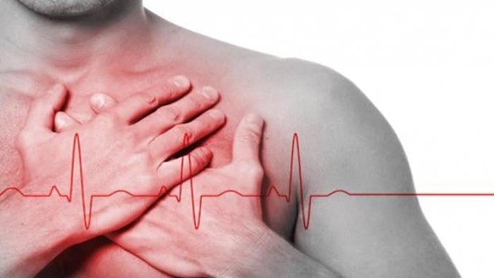 Infarto