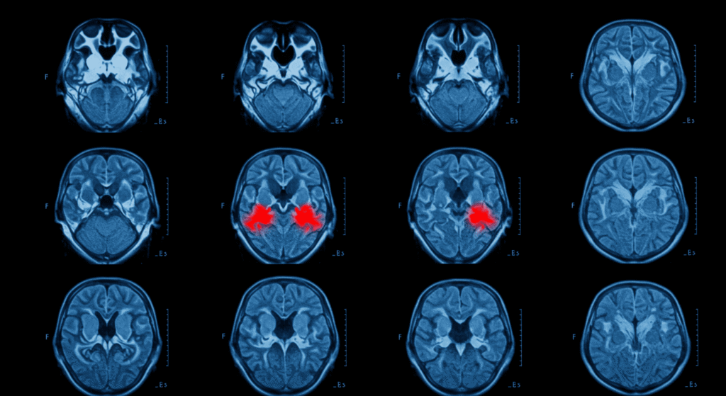 La Antimateria y sus posibles aplicaciones 4 Resonancia magnética (RM) del cerebro mostrando cortes axiales con áreas destacadas en rojo. Imagen médica para diagnóstico y estudio del cerebro.